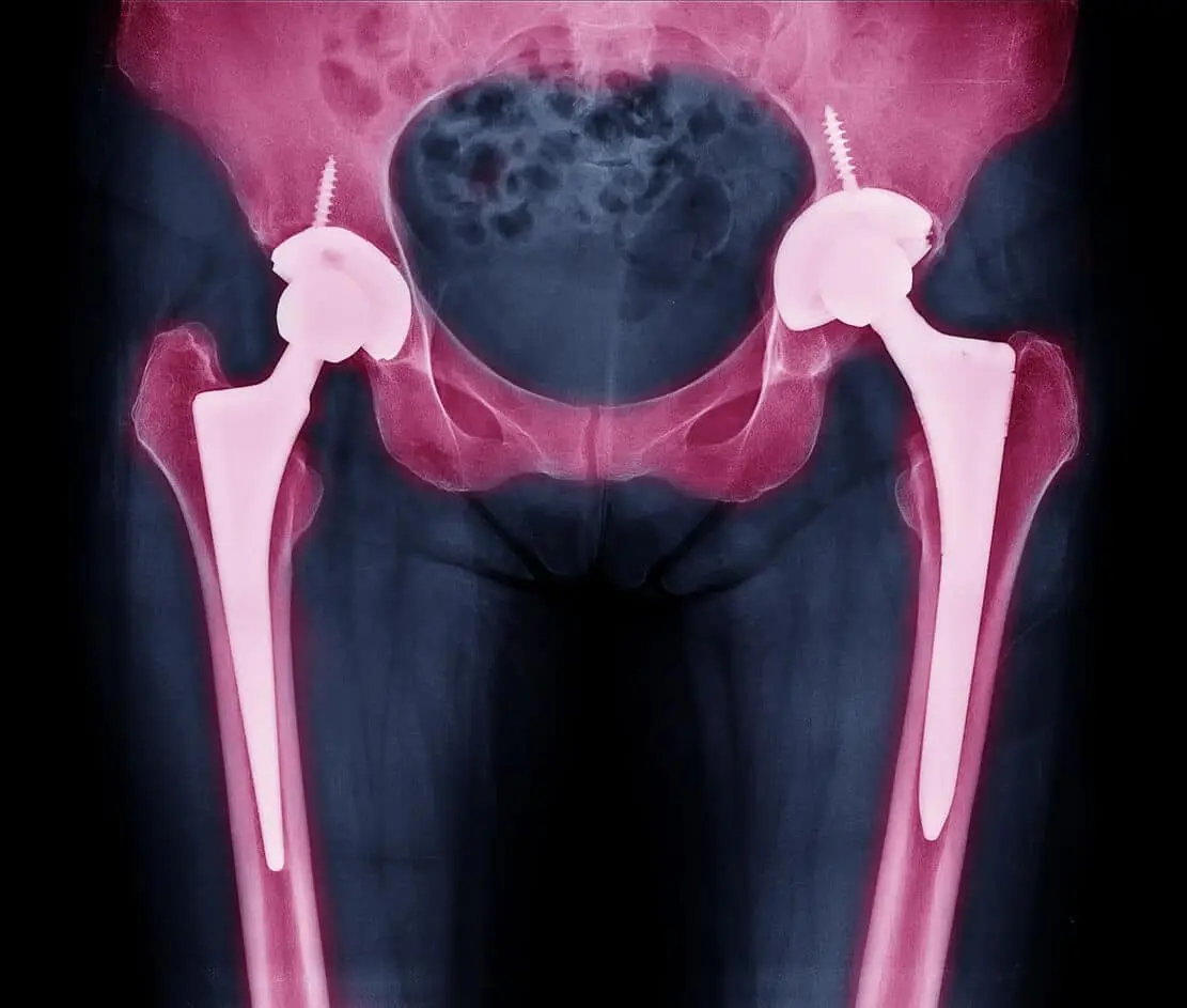 Best Hip Replacement: A Guide for Active Adults