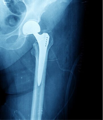 Personalized Orthopedics of the Palm Beaches - joint pain - joint replacement surgery