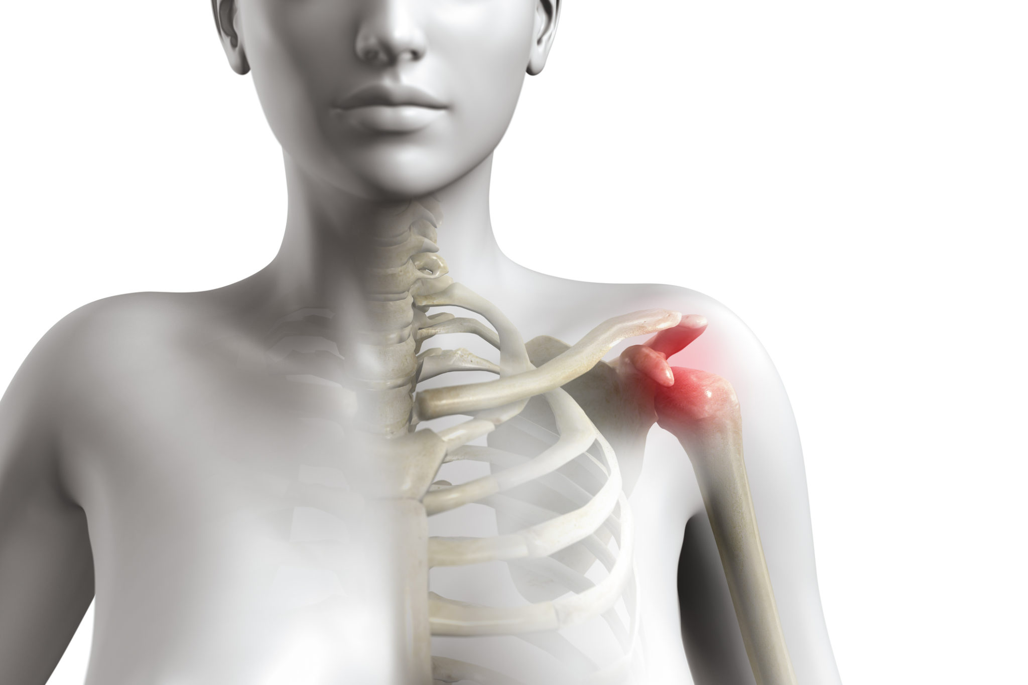 Treatments for a Shoulder Impingement