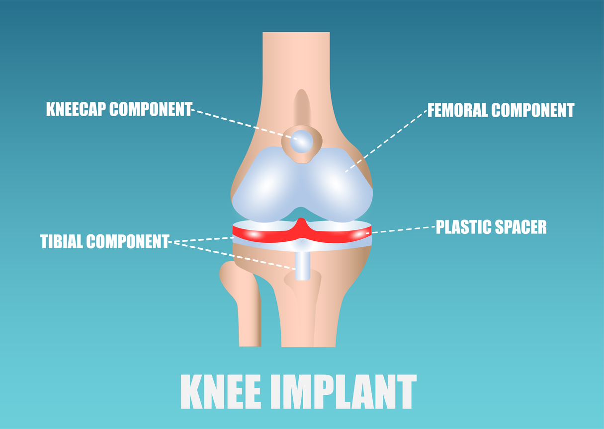 knee joint replacement devices